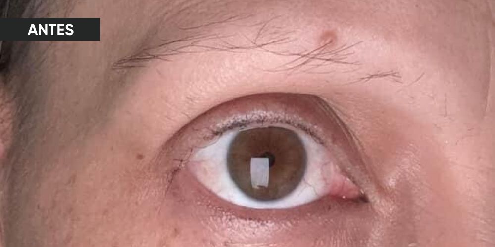 Antes